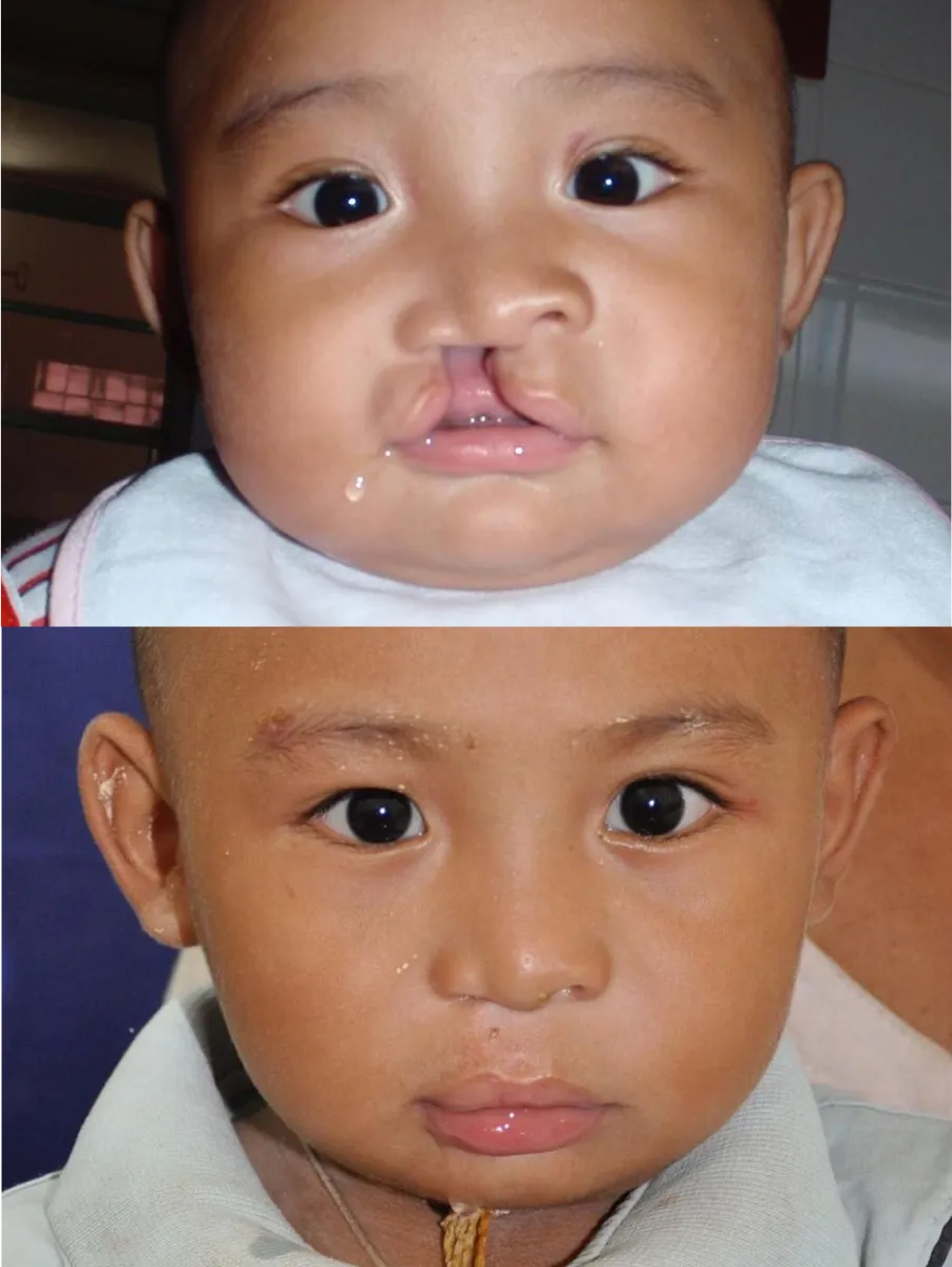 drberkei rhinoplasty charity 1